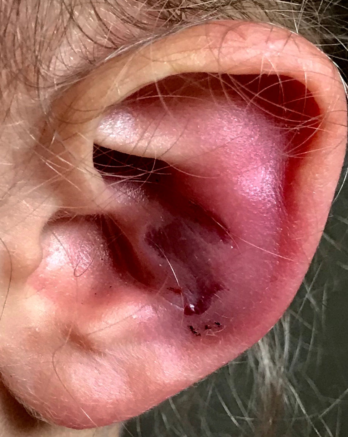 Cauliflower ear 