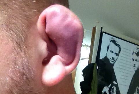 Cauliflower ear that needs to be drained