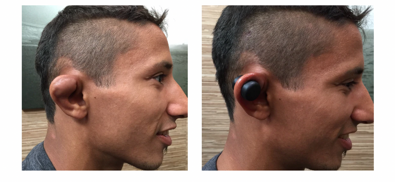 caulicure used on swollen ear for cauliflower ear prevention